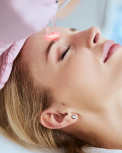 IPL for Rosacea, Redness, and Sun Damage